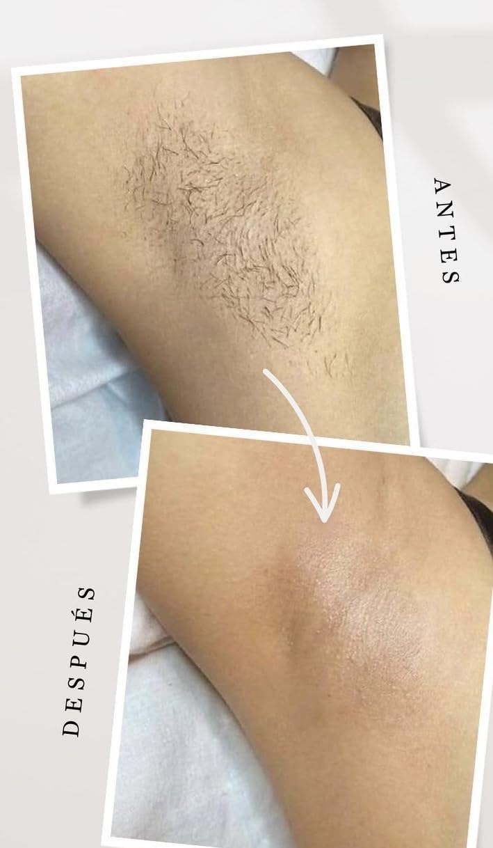 INIA Laser Hair Removal with Ice-Cooling Care for Women and Men, HAUTE Pro Painless at-Home IPL Hair Remover for Coarse Hair in Bikini All Body Areas, Latest Generation for Effective Results customer photo 1